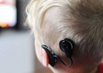 Día Internacional del Implante Coclear