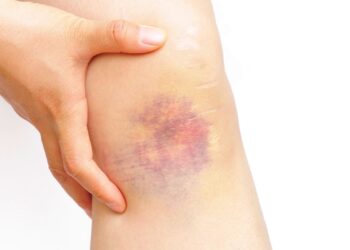 ¿Porque salen los moretones?