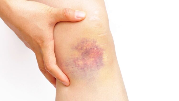 ¿Porque salen los moretones?