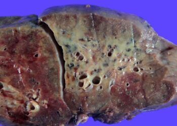  Este es el daño que provoca el coronavirus en los pulmones