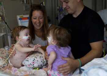 Médicos separan a siamesas de 1 año en Estados Unidos