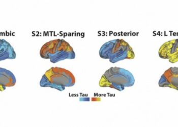 Científicos encuentran cuatro diferentes tipos de Alzheimer