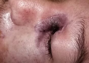 Confirman posible primer caso de Hongo Negro en México