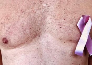 Detectan a 5 varones con cáncer de mama en Tampico