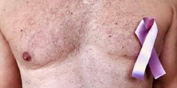 Detectan a 5 varones con cáncer de mama en Tampico