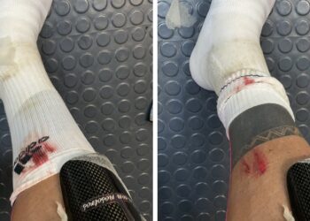 Así quedó la herida que sufrió Carlos Salcedo ante el partido contra Santos.