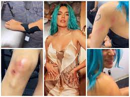 Karol G muestra golpes que sufrió tras caída en concierto
