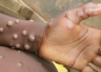 Confirman 7 casos de viruela del mono en España y Portugal; hay 40 sospechosos
