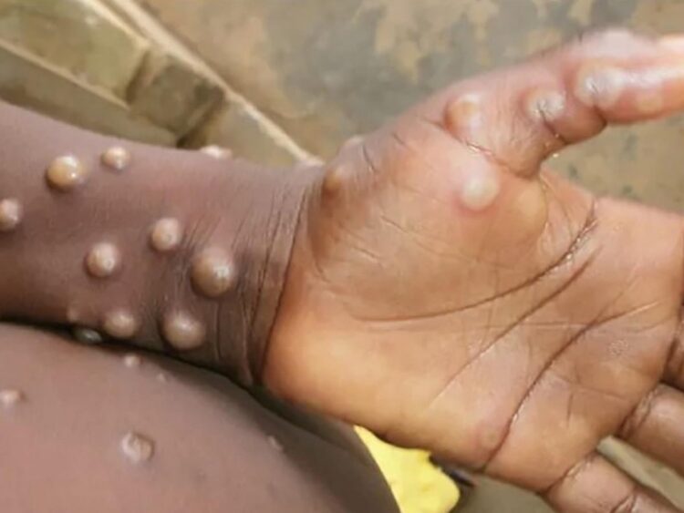 Confirman 7 casos de viruela del mono en España y Portugal; hay 40 sospechosos