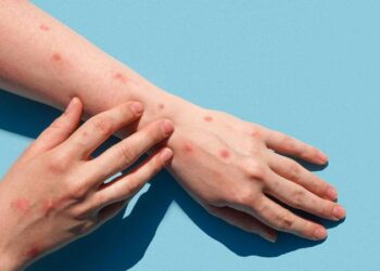 Confirman segundo caso de viruela del mono en la Cd. de México