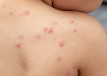 Viruela del mono en México: detectan caso en Puerto Vallarta