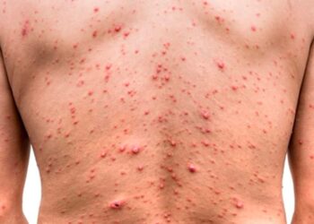 Aumenta a 42 los casos de viruela simica en Texas