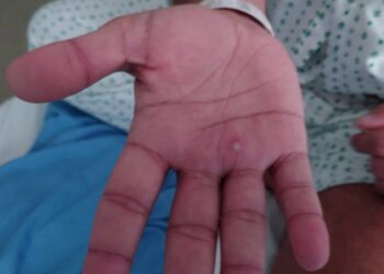 OMS declara emergencia de salud mundial por brote de viruela del mono