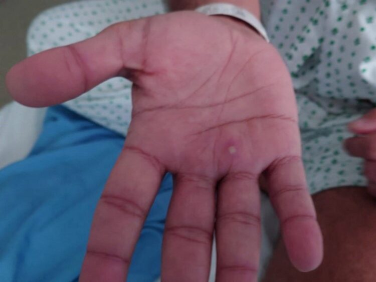 OMS declara emergencia de salud mundial por brote de viruela del mono