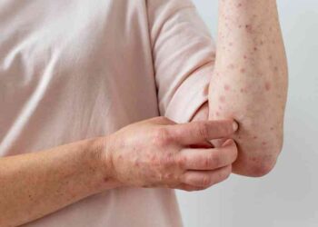 Estados Unidos reporta primeros casos de viruela del mono en niños