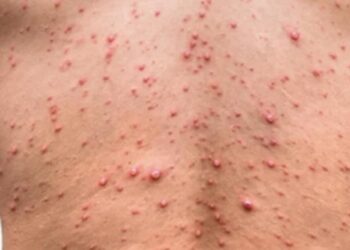 La viruela del mono de humano a perro sí es posible; esto recomienda la OMS