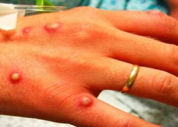 Nuevo León reporta otros 10 casos sospechosos de viruela del mono