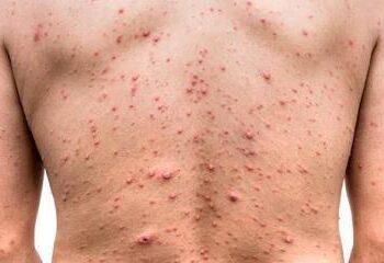 Aumenta a 813 casos viruela símica en Texas