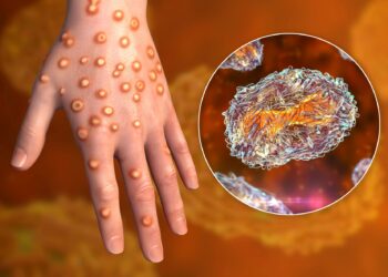 Confirman primer caso de viruela símica en Condado Hidalgo