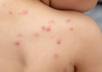 Registra México 386 casos de viruela símica