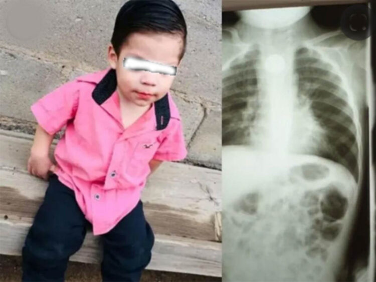 Bebé se traga pila y acaba con quemadura de esófago y pulmón infectado