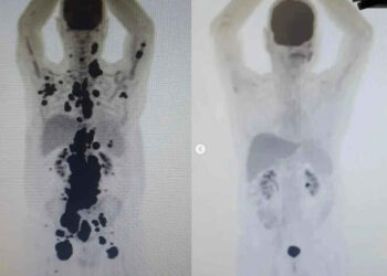 El antes y el después del paciente que venció al cáncer con novedoso tratamiento