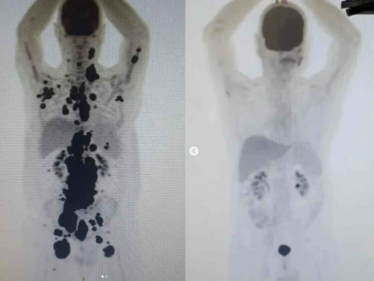 El antes y el después del paciente que venció al cáncer con novedoso tratamiento