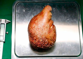 Médicos en Sri Lanka extraen el cálculo renal más grande del mundo