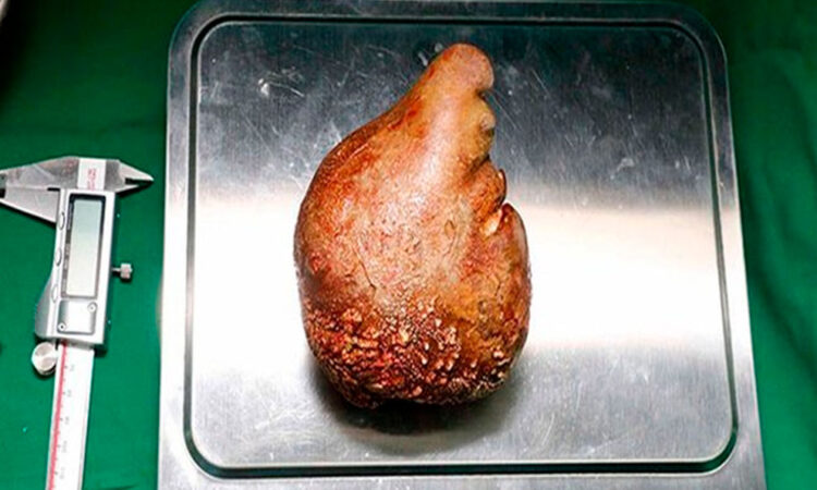 Médicos en Sri Lanka extraen el cálculo renal más grande del mundo