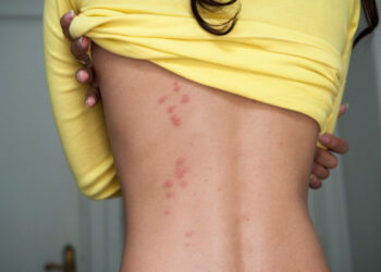 Este tipo de ronchas y lesiones dejan las chinches en tu cuerpo