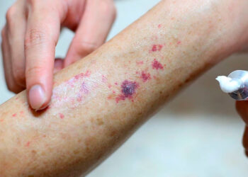 Alerta en EE.UU parásito tropical que afecta la piel preocupa a expertos