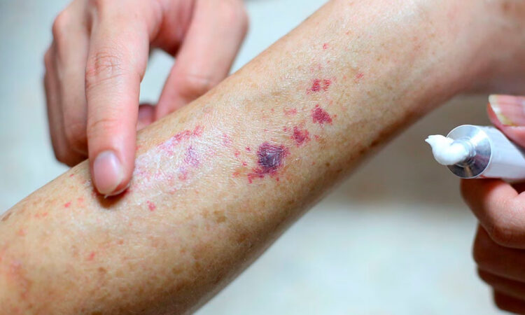 Alerta en EE.UU parásito tropical que afecta la piel preocupa a expertos