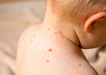 La OMS alerta sobre un aumento de casos de sarampión en Europa