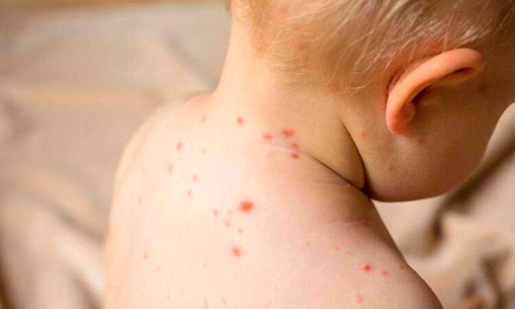 La OMS alerta sobre un aumento de casos de sarampión en Europa