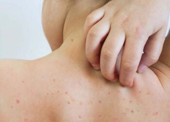 OMS: Más de la mitad de los países enfrentan riesgo alto de brotes de sarampión para finales de 2024