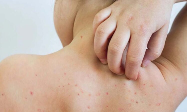 OMS: Más de la mitad de los países enfrentan riesgo alto de brotes de sarampión para finales de 2024