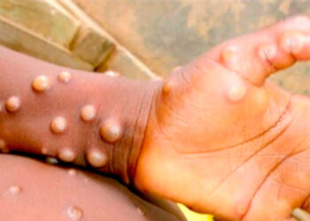 Alerta de la UE por rebrote de viruela del mono en África