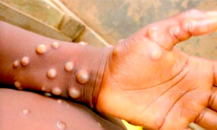 Alerta de la UE por rebrote de viruela del mono en África