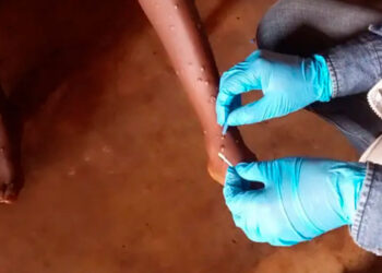 Mpox en África: más de 22.800 casos y 622 fallecidos