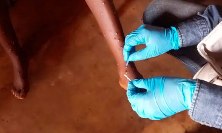 Mpox en África: más de 22.800 casos y 622 fallecidos