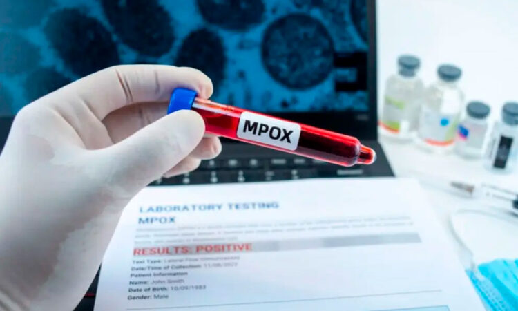 Sin casos de mpox en Latinoamérica, pero activan vigilancia