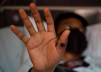 Sudáfrica refuerza medidas para evitar propagación del mpox