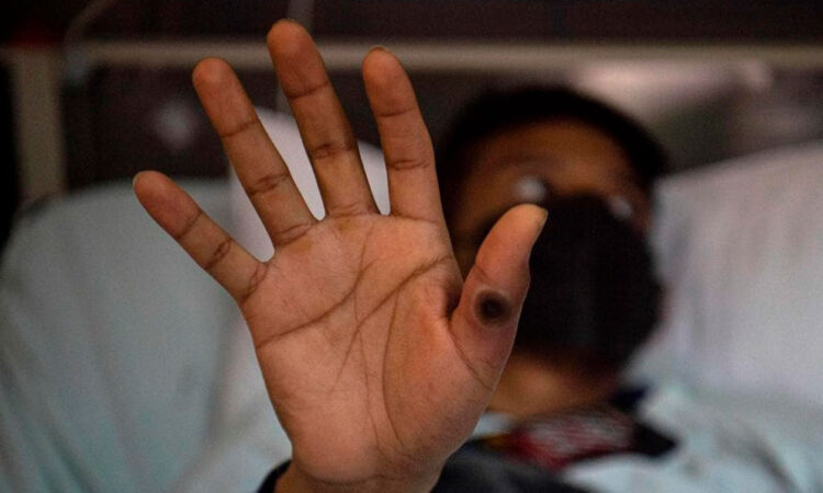 Sudáfrica refuerza medidas para evitar propagación del mpox