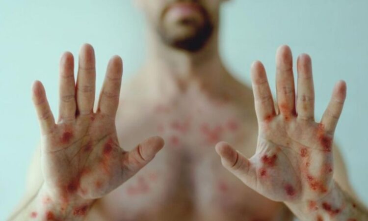 Confirman caso de nueva variante de viruela del mono en Argentina