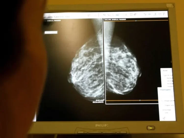 FDA aprueba nuevo tratamiento contra el cáncer de mama en etapas tempranas