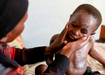 Desnutrición agrava brote de mpox en el Congo