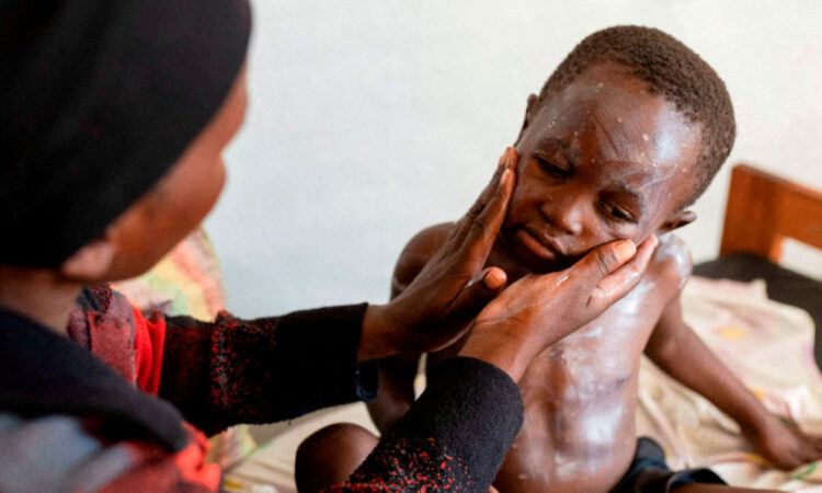 Desnutrición agrava brote de mpox en el Congo