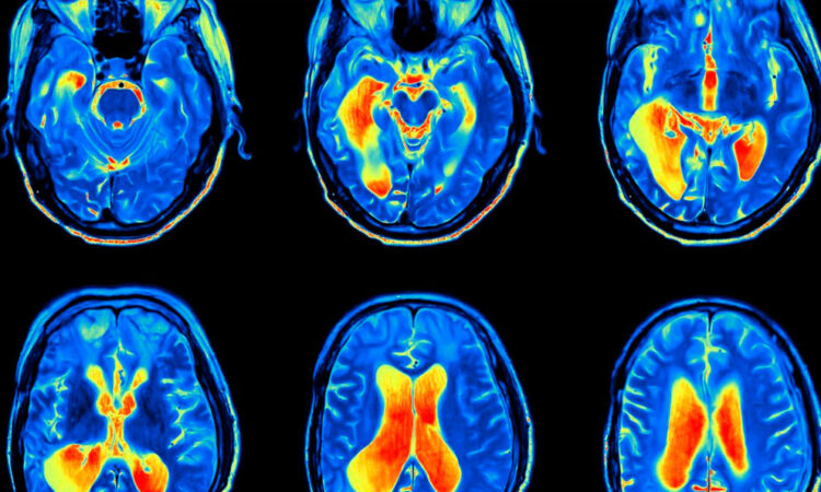 Efectos del confinamiento en el cerebro adolescente