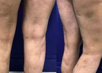 El sufrimiento del retiro de biopolímero con cirugía abierta