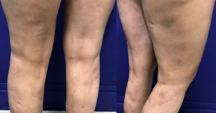 El sufrimiento del retiro de biopolímero con cirugía abierta